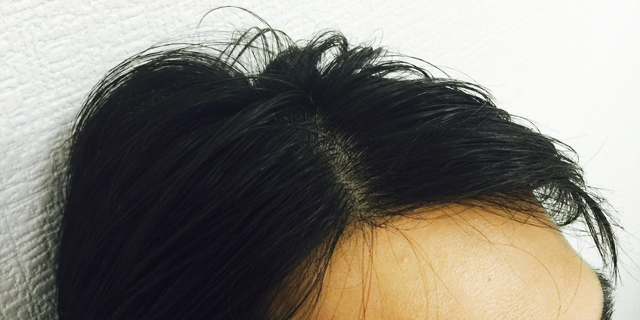 前髪の後退が気になる
